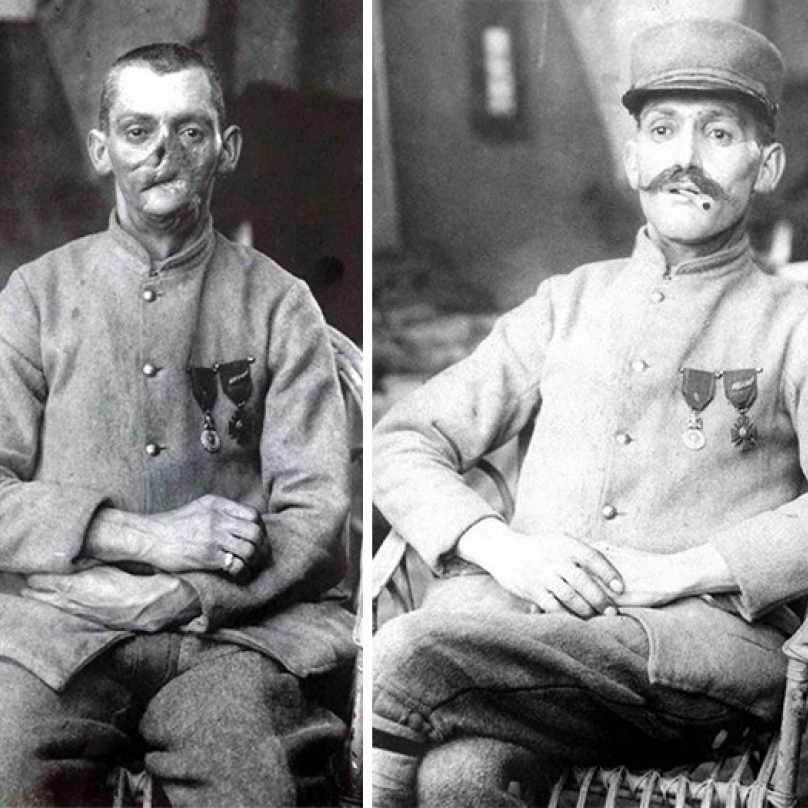 Na první pohled se může zdát, že se jedná o dvě rozličné osoby. Na druhém snímku stejný voják s maskou. Zranění obličeje byla velmi častá, neboť vojáci museli čas od času vystrčit ze zákopu hlavu, aby se rozhlédli.